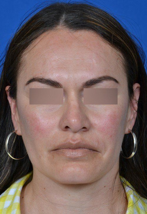 revision rhinoplasty front before picture