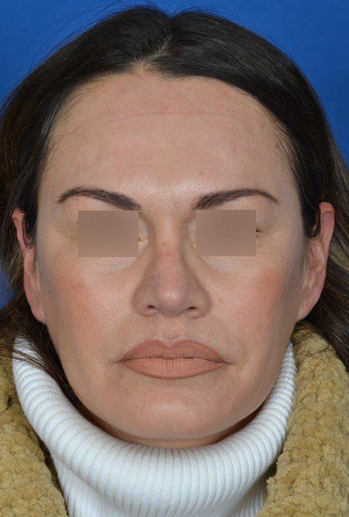 revision rhinoplasty front before picture
