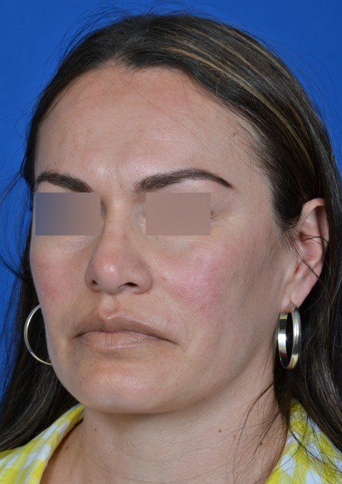 revision rhinoplasty