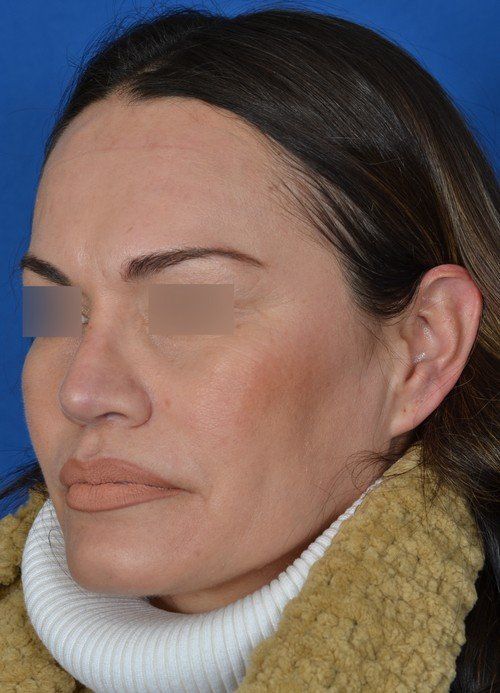 revision rhinoplasty