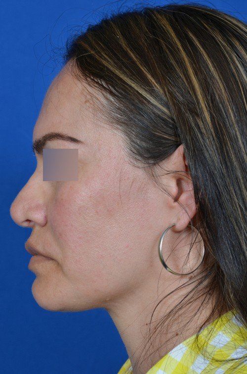 rhinoplasty side profile