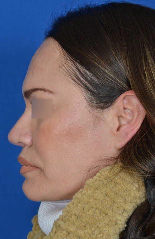 rhinoplasty side profile