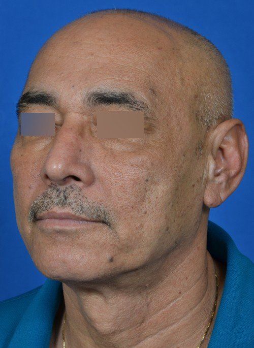 male rhinoplasty after