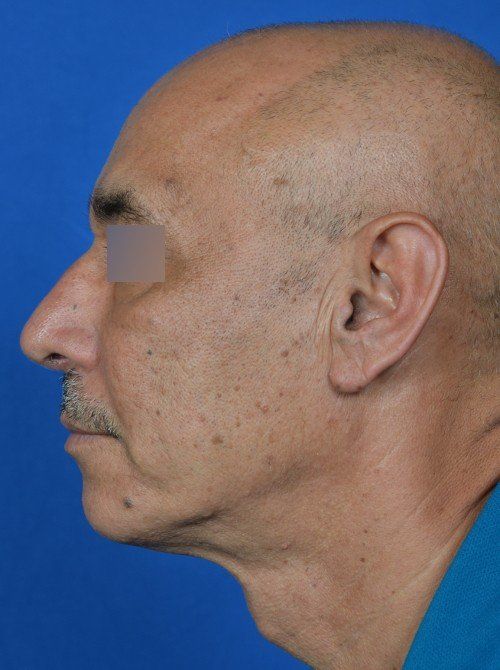 male rhinoplasty after