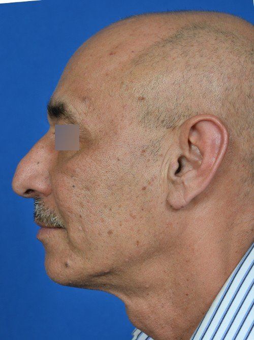 male rhinoplasty