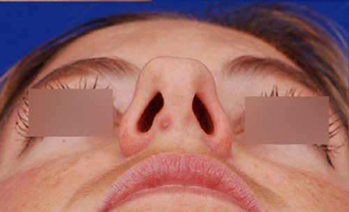 rhinoplasty