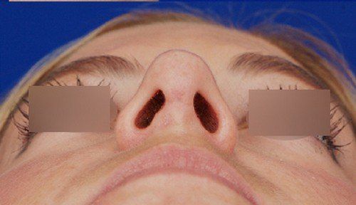 rhinoplasty