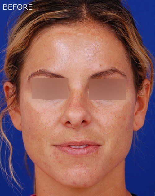 female rhinoplasty