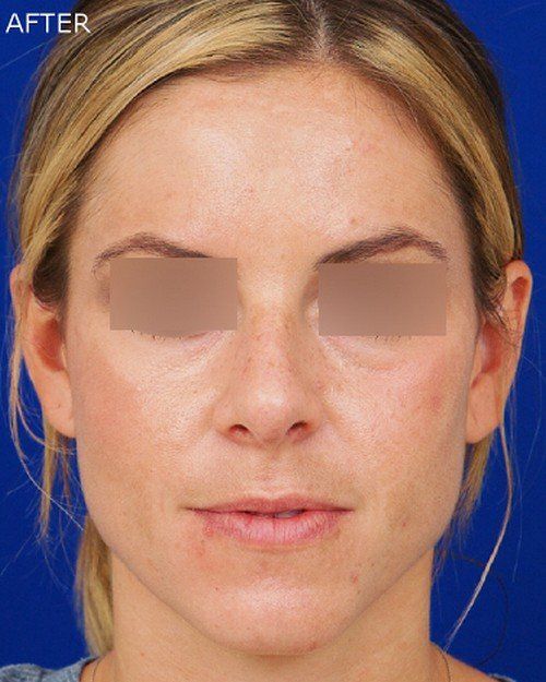 rhinoplasty