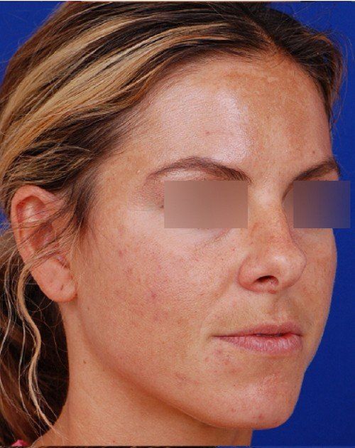 rhinoplasty