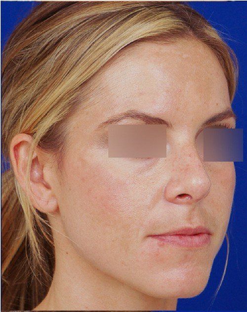 female rhinoplasty