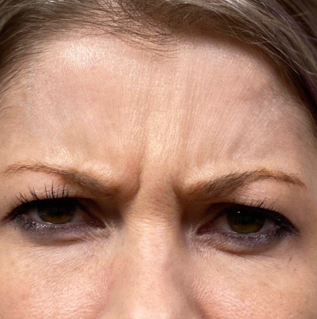 Female After Botox for Glabellar Lines