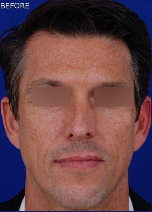 male rhinoplasty