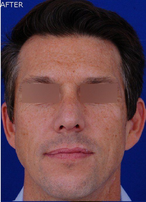 male rhinoplasty