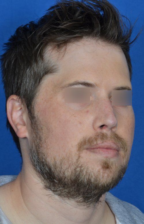 revision rhinoplasty example