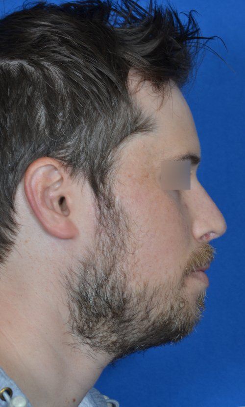 rhinoplasty before and after