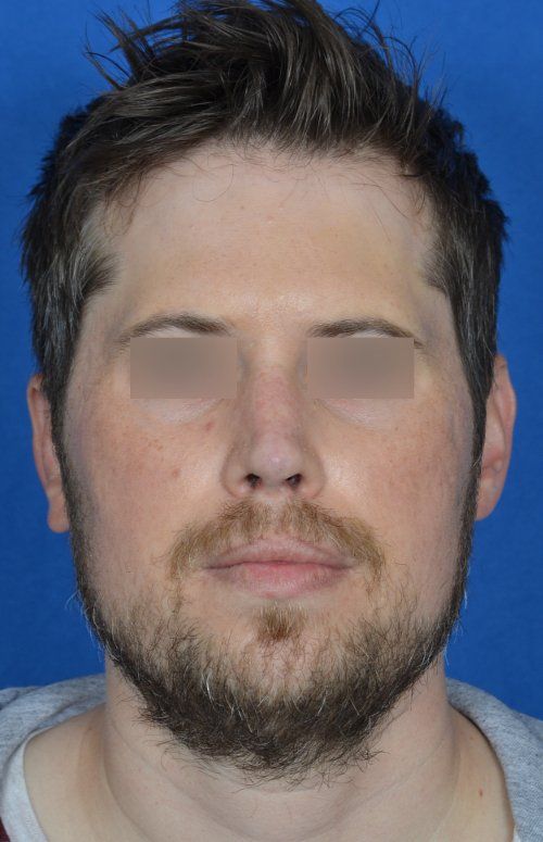 revision rhinoplasty example