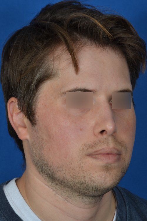revision rhinoplasty example