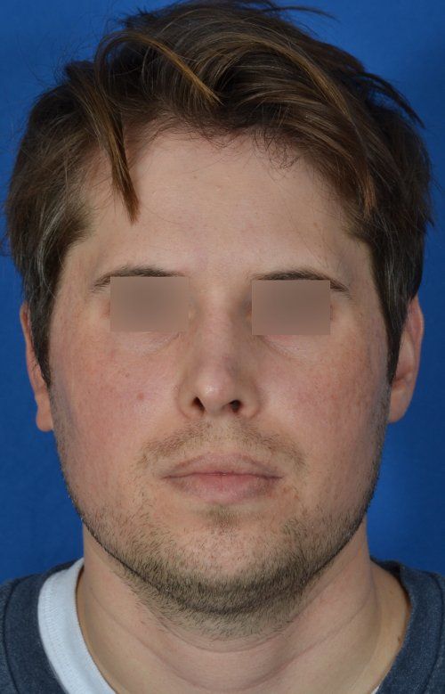 revision rhinoplasty example