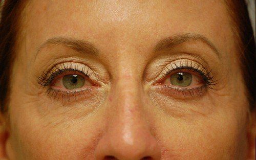 undereye wrinkles
