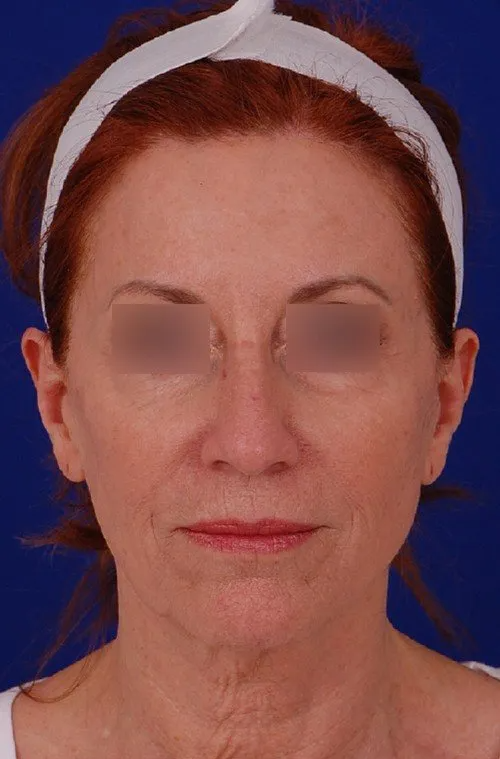 women before neck lift