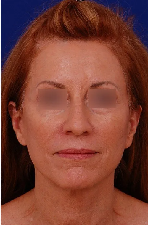woman after neck lift