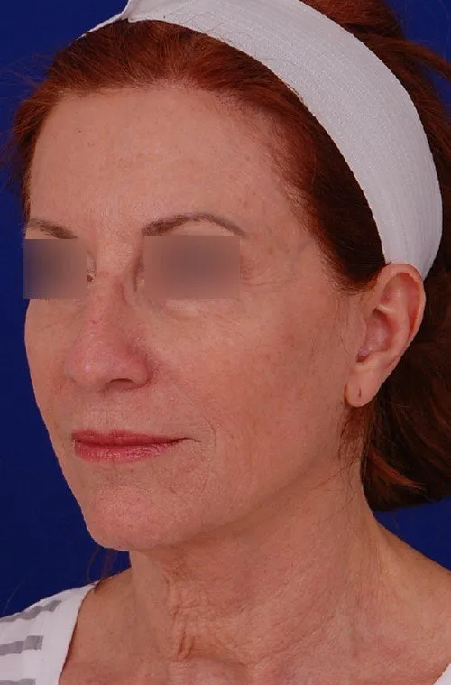 female facelift