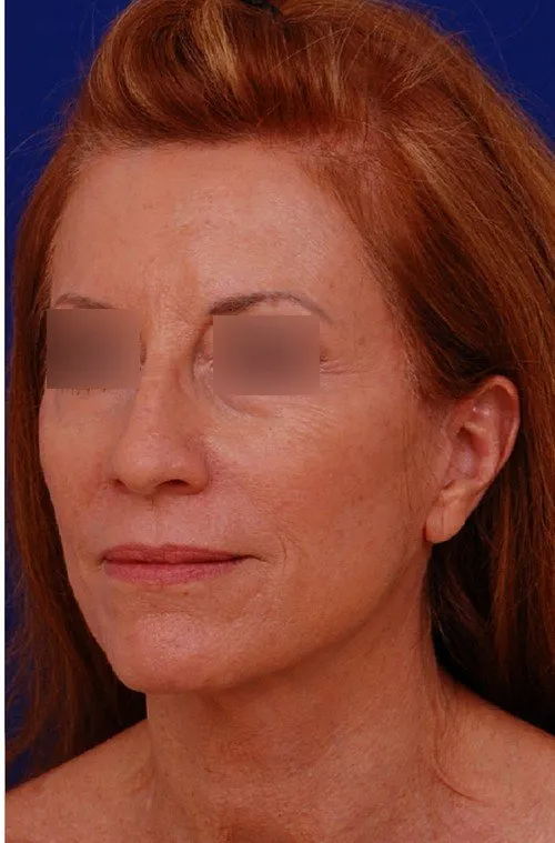 female facelift