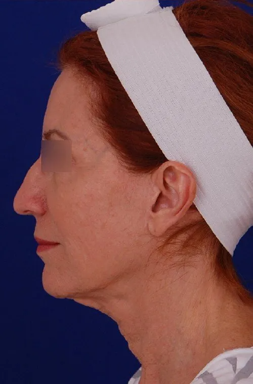 female facelift