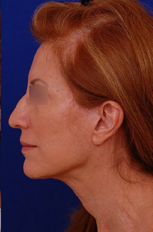 female facelift