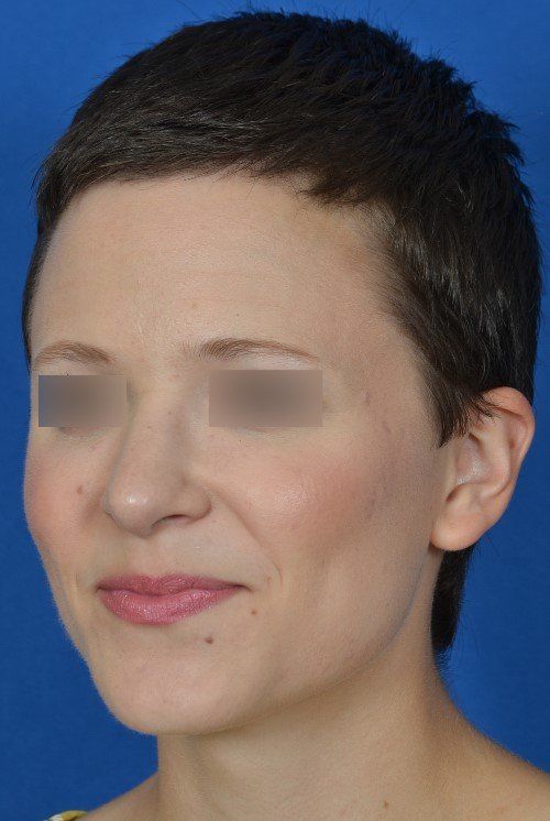 rhinoplasty