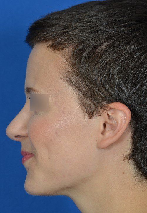 rhinoplasty