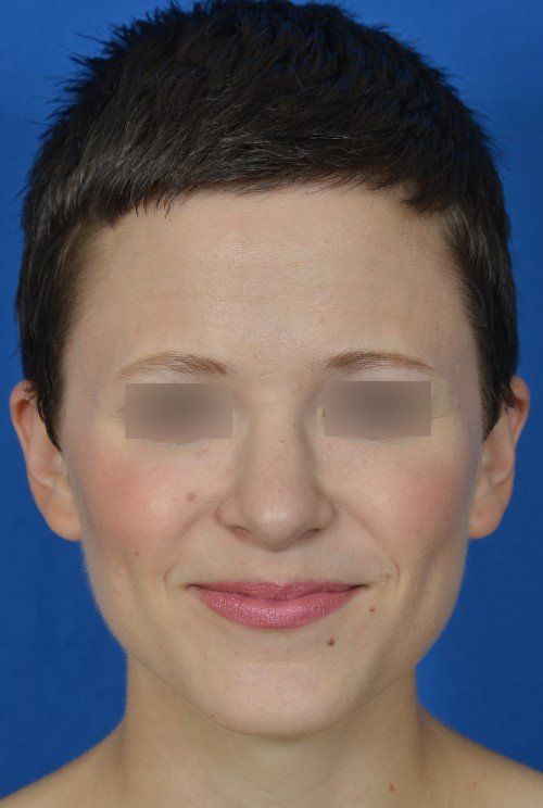 rhinoplasty