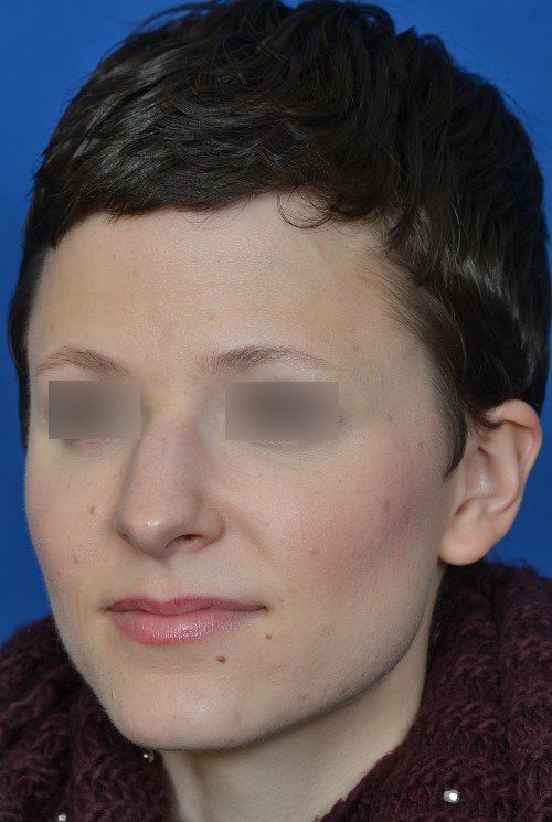 rhinoplasty