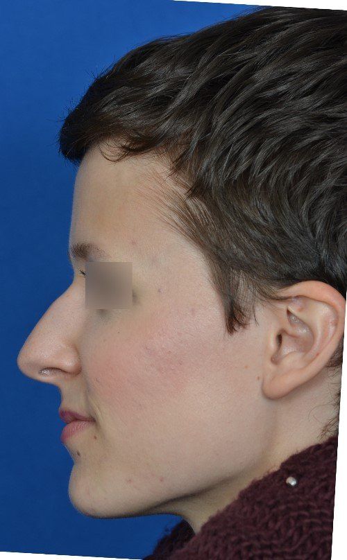 rhinoplasty