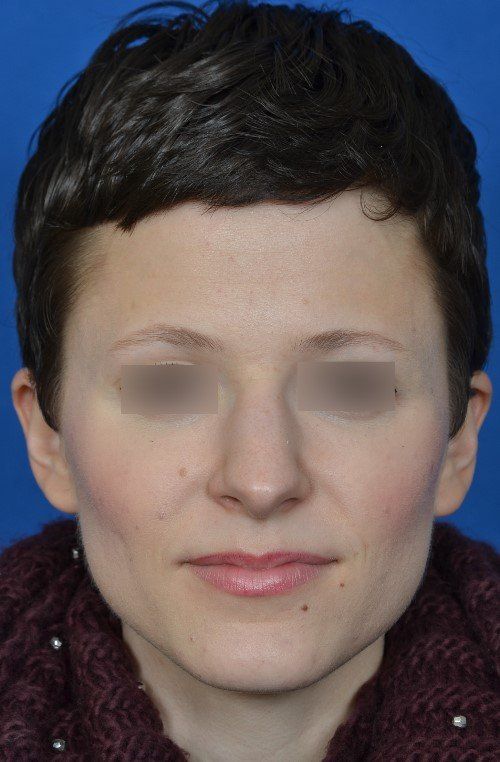 rhinoplasty