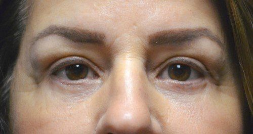 blepharoplasty before and after