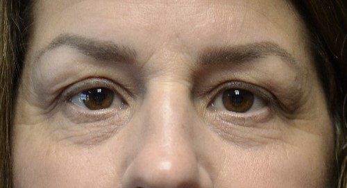 blepharoplasty before and after
