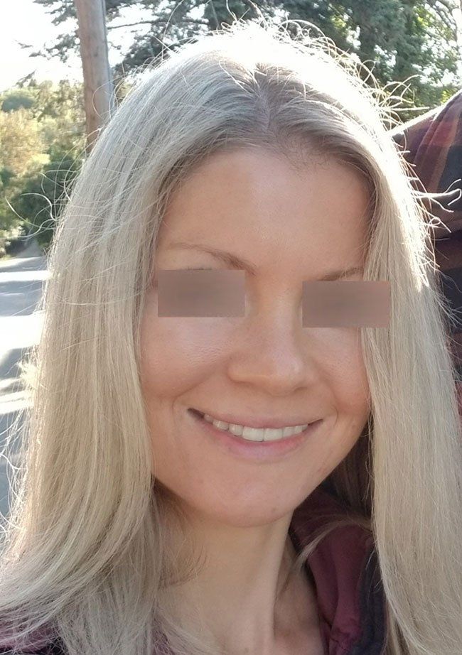 after 3 stimulator peels