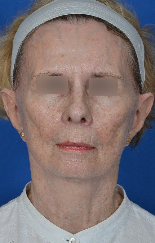 mini facelift before and after