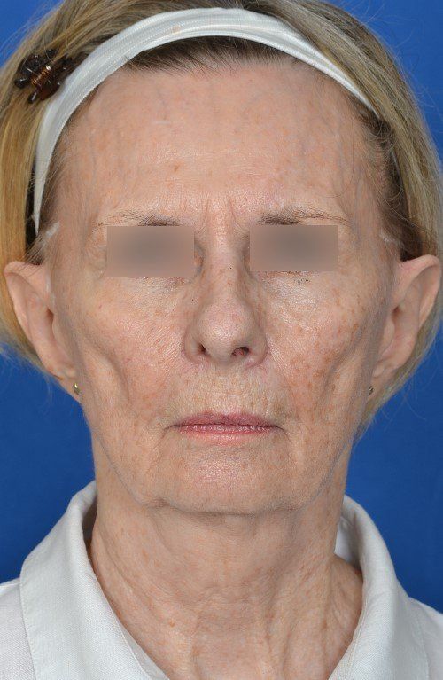 mini facelift before and after