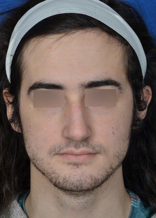 male rhinoplasty