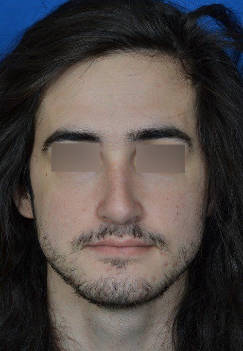 male rhinoplasty