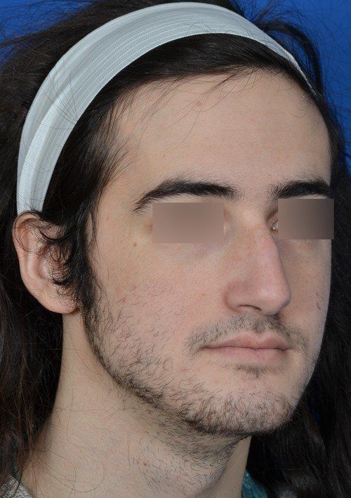 male rhinoplasty
