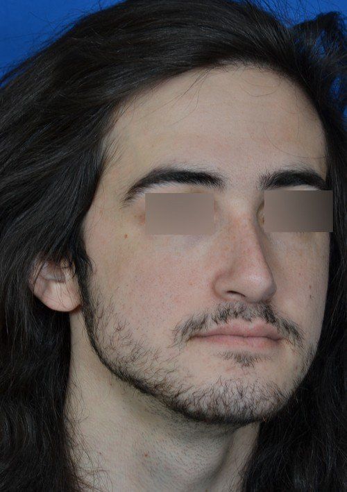 male rhinoplasty