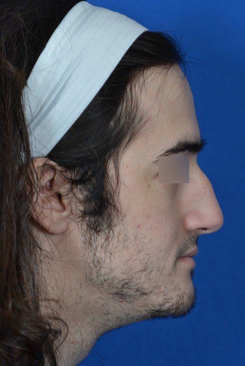 rhinoplasty