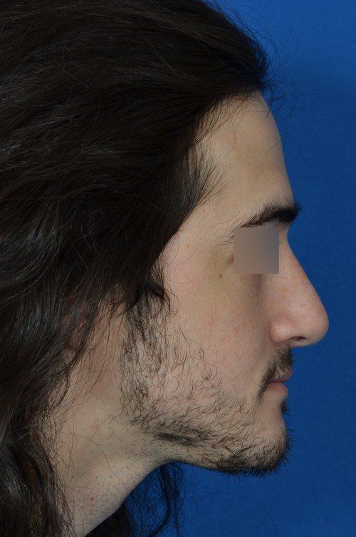 rhinoplasty side view