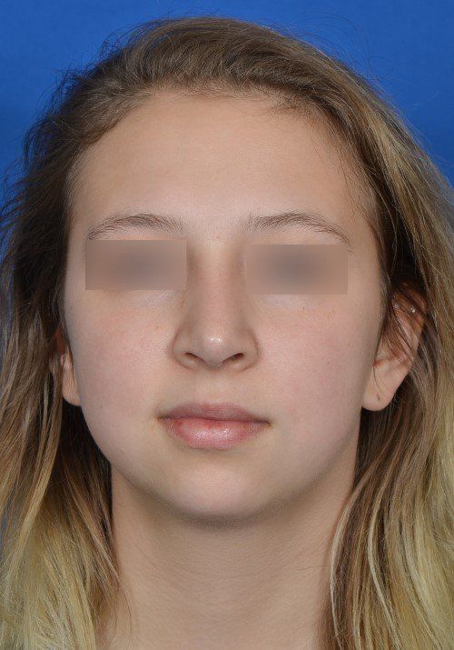 rhinoplasty