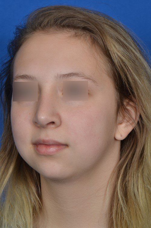 rhinoplasty