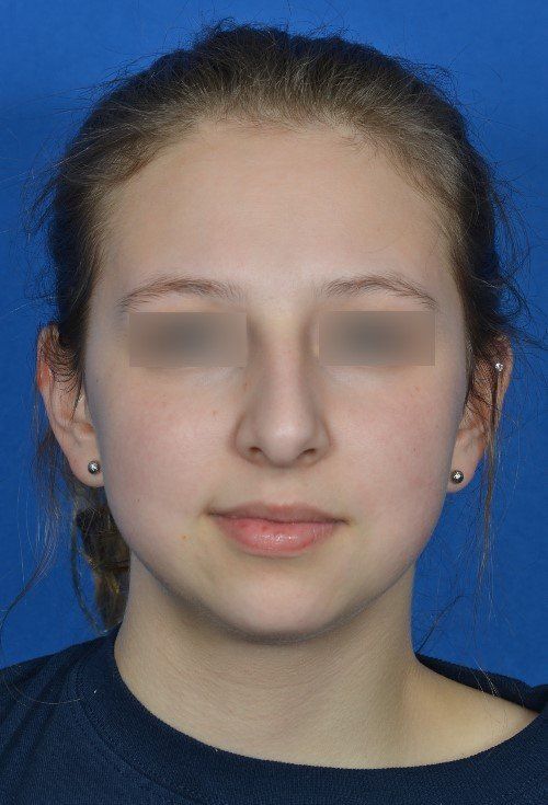 rhinoplasty